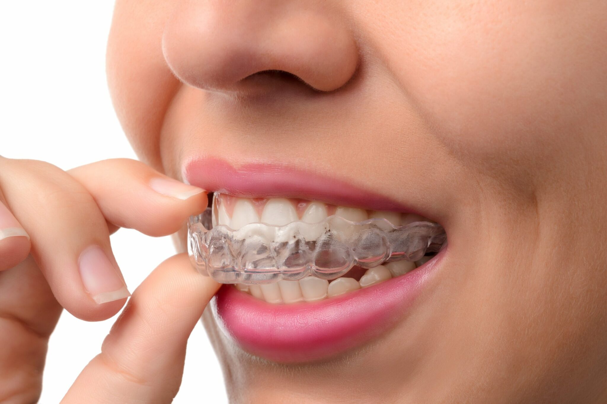 What To Do If You Lose An Invisalign Tray- (Don't Panic!)